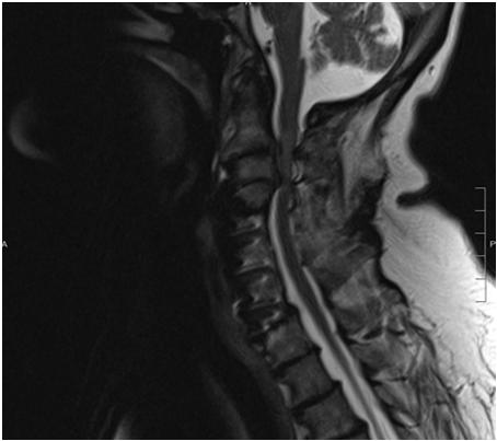 and/or facet joints, OPLL, calcified discs X-ray: cervical lordosis, listhesis,