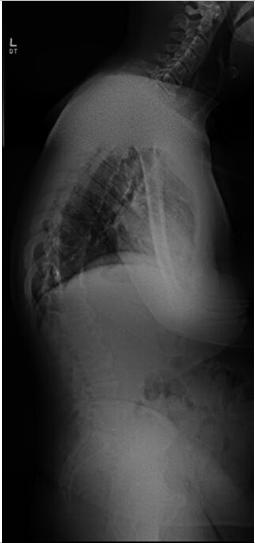 Correct spinal alignment (deformity) Comorbidities Prior fusion/instrumentation Open Osteotomies SPO, VCR, PSO