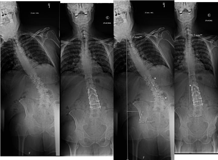 Feels slightly off to the R, but much happier Case 1 MIS surgery for spine trauma?