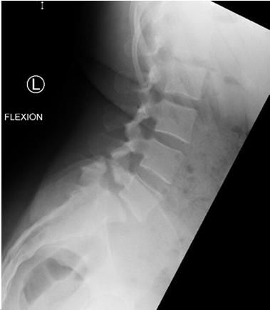 Radiculopathy and/or back pain Percutaneous instrumentation Spinal fractures