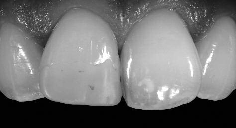 Clinical How to build up the perfect tooth Ulf Krueger-Janson 1 The natural appearance of a tooth can be successfully reconstructed with a composite resin that is based on an integrated shade and