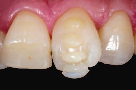 Clinical Figure 2: Incisal view: Uneven vestibular contour. The neighbouring tooth 21 shows that in order for the tooth to appear lifelike, it needs to be positioned like a butterfly wing.