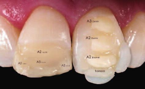A straightforward method is available for gaining a general impression of the shade layers of the natural neighbouring tooth.
