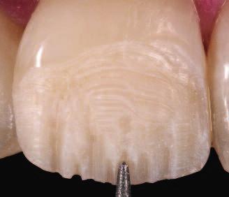 Figure 6: The basic shape and colour of tooth 11 have been recreated. The overall appearance corresponds to that of the adjacent tooth.