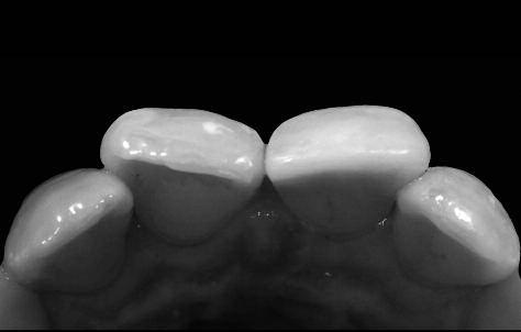 Finally, the Re-examination is important One week after the completion of the restoration, the tooth 10 was clinically evaluated and checked with regard to the adaptation of the shade to that of the