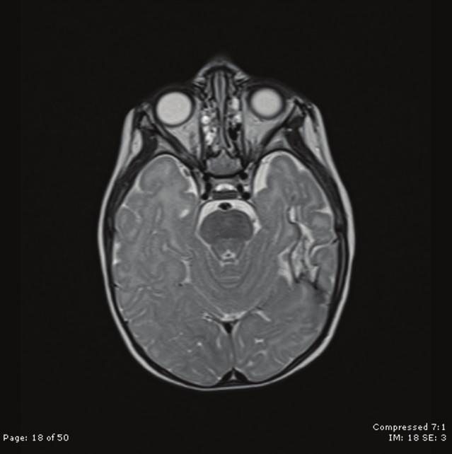 resulting from an interaction between the early lesion and the developing brain [20] although further research is needed to refine this understanding.