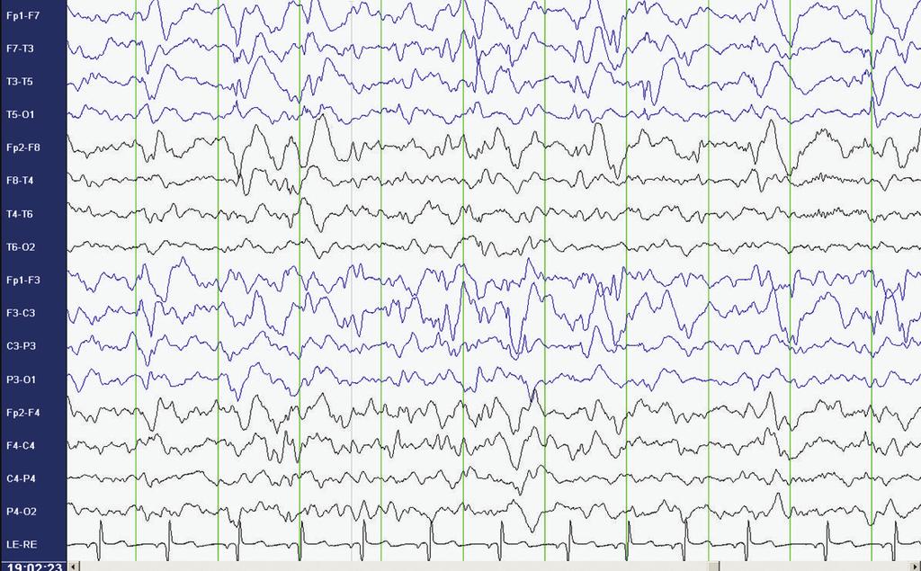4 Epilepsy Research and Treatment Figure 4: EEG prior to surgery showing multifocal sharp waves in the left and right temporal and frontal regions, maximal on the left side.