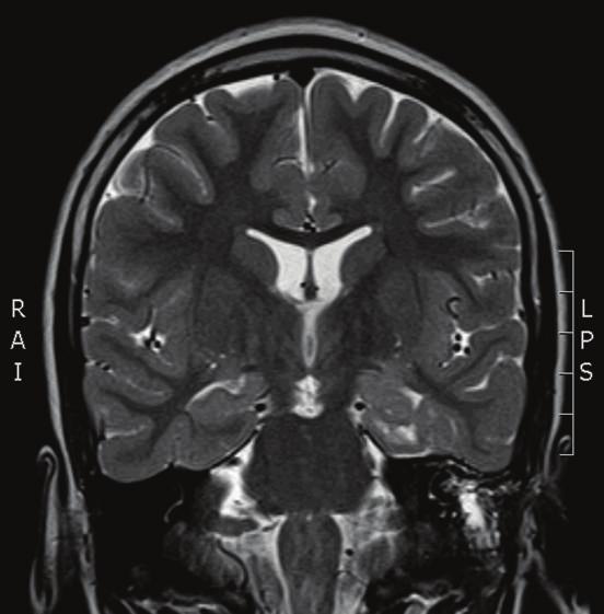 Some of her seizures involve left hand dystonic movement and secondary generalization. Interictal EEG showed multifocal sharp waves in the left and right temporal and frontal regions.