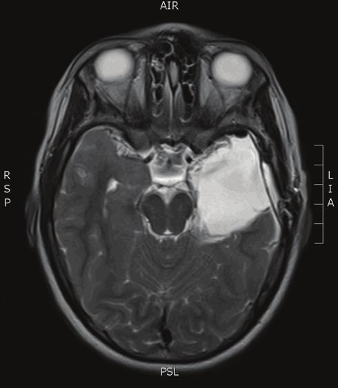 Epilepsy Research and Treatment 5 Figure 7: Postoperative axial T2-WI MRI scan at the same level after left temporal lobe resection. (WHO grade I).