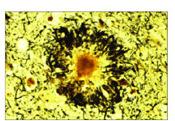 Neurotoxic forms of amyloid-β Fibrils Deposit in senile plaques Aβ natively unfolded monomer protofibrils fibrils Bind to neurons low-n 6mer 12mer (Aβ*56) ADDLs