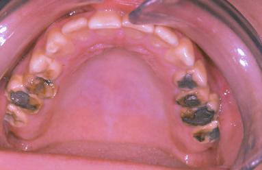 attrition. D: Lateral cephalogram of patient. posterior teeth wear along with masticatory inefficiency (Fig.1B&C).