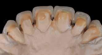 partial dentures Benefits Ease of use Rapidity of execution of the