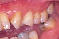 Cervical caries 2.