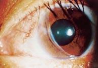 Patients who had systemic diseases such as Wegener s granulomatosis, rheumatoid arthritis, and systemic lupus erythematosus, which could cause peripheral corneal ulcer, were excluded from Figure 3