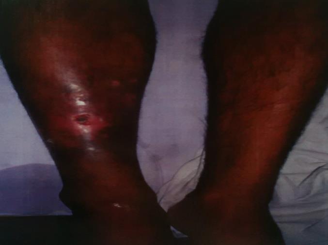 3 3 1 1 NO NO NE SINGL E TWO SINGLE TWO > TWO No. of symptoms > TWO Figure 3: Association of various clinical symptoms with DVT. Figure : DVT with primary presentation of chronic non-healing ulcer.