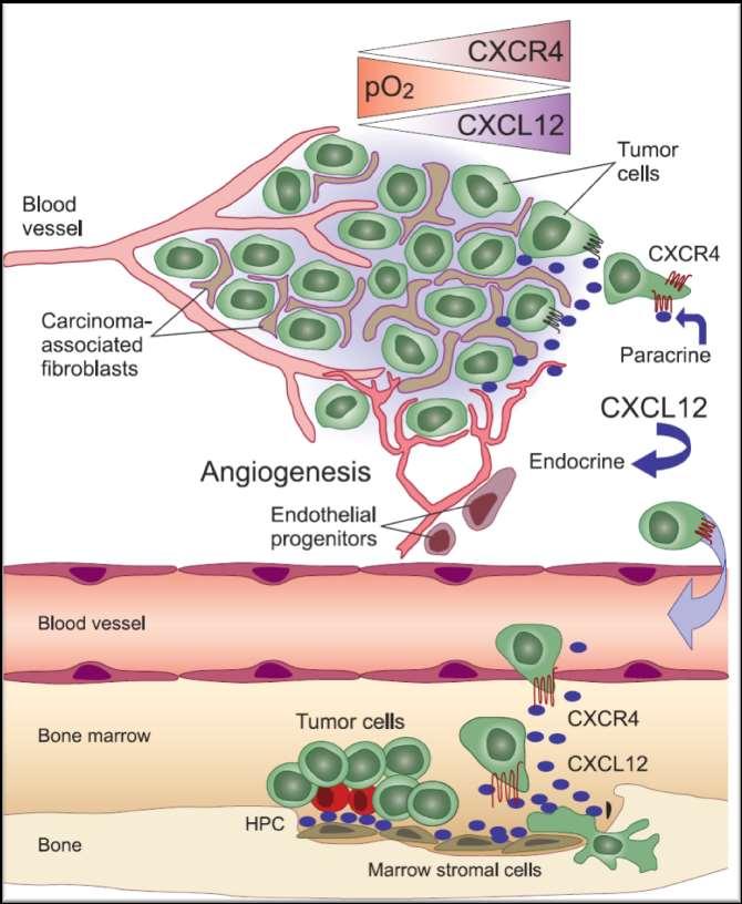 Renal Cell Carcinoma and CXCR4 The CXCR4 chemokine receptor is expressed in many tumors, including clear cell RCC, where it promotes angiogenesis and enhances tumor infiltration by myeloidderived