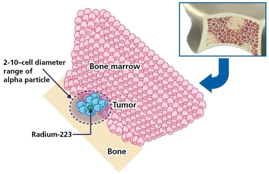 Targeting Bone Metastases Radium-223 a-particles induce dsdna breaks in adjacent tumor cells Short penetration of a emitters