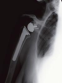 Surgical Procedure This procedure to replace your shoulder joint with an artificial device usually takes about 2 hours.