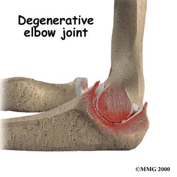 It is also tough enough to last a lifetime, if it is not injured. Causes What causes osteoarthritis? Osteoarthritis is caused by degeneration of the articular cartilage of a joint.