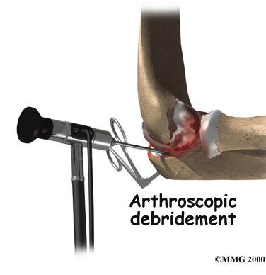 Arthroscopic procedures use an arthroscope, a tiny TV camera that is inserted into the joint through a very small incision. The arthroscope allows the surgeon to see inside the elbow joint.