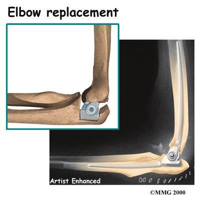 An elbow fusion will greatly decrease the motion in your arm. However, it does leave you with a strong and pain-free elbow.