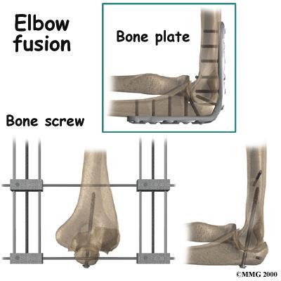 Elbow Joint Replacement Elbow joint replacement or total elbow arthroplasty (TEA) is not nearly as common as hip, knee, or shoulder replacement. This is true for a couple of reasons.