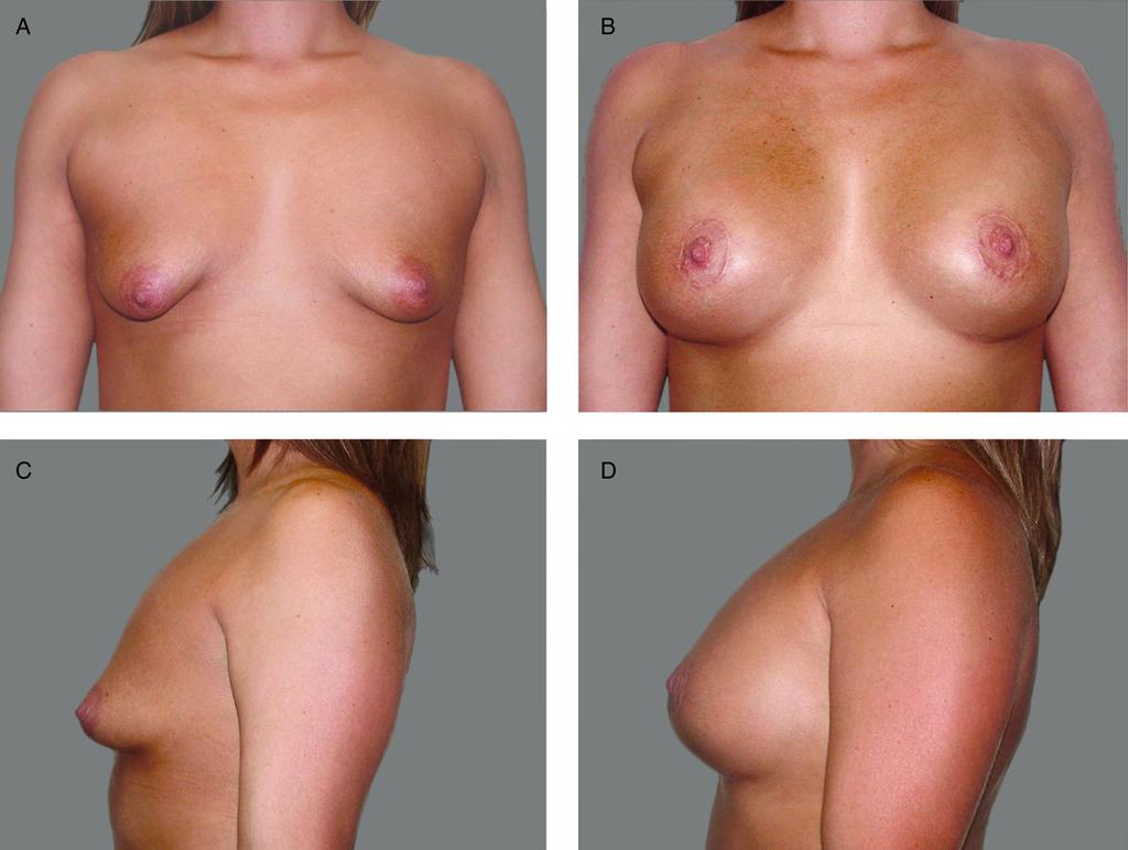 Schwartz et al S31 Figure 5. Dr Movassaghi s breakthrough case. (A, C) This 32-year-old woman with tuberous breast deformity and asymmetry desired natural-looking breasts.
