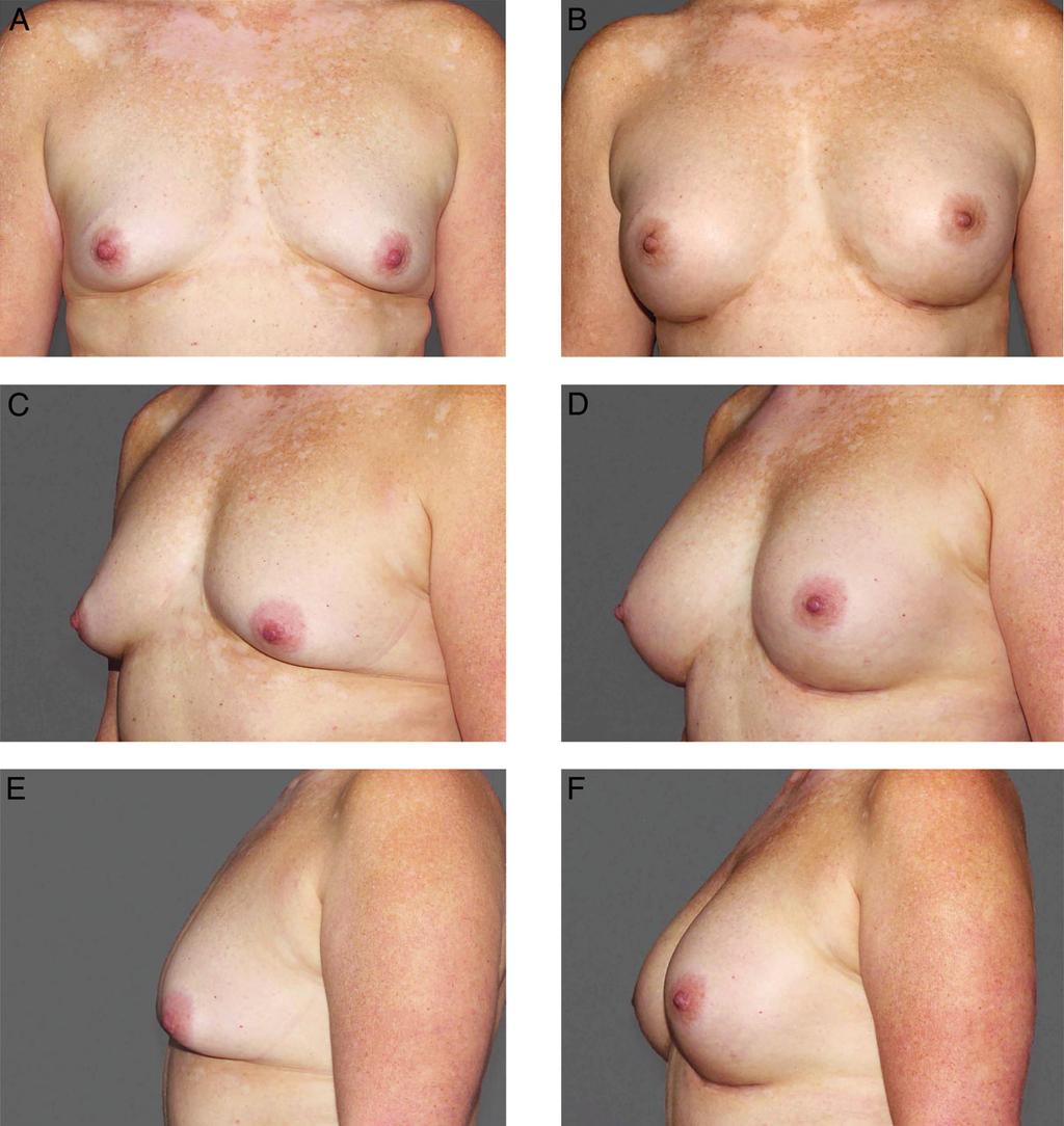 Schwartz et al S25 Figure 1. Dr Schwartz s breakthrough case. (A, C, E) This 48-year-old woman with a severely tight inframammary fold desired a larger, natural augmentation.