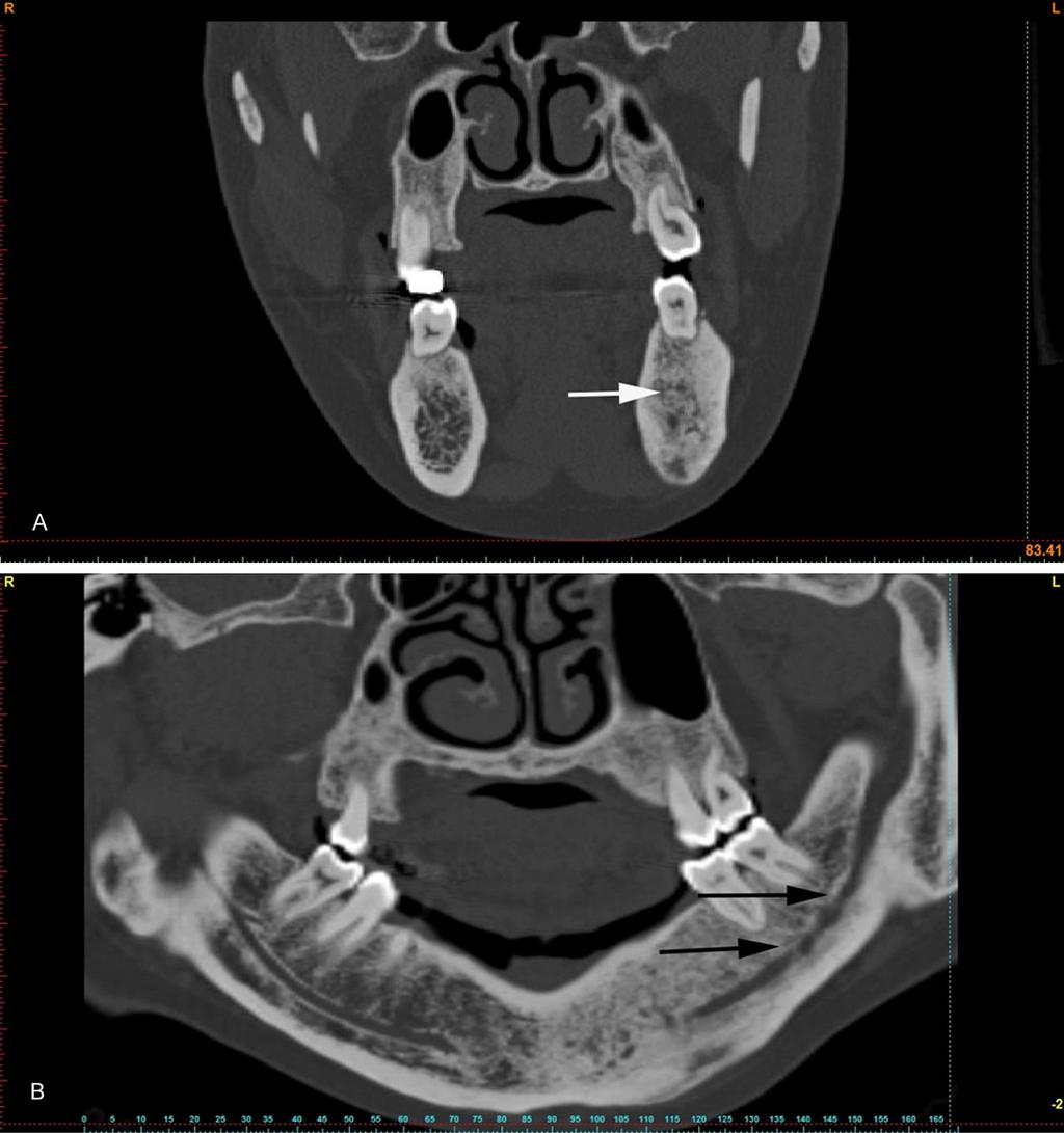 Figure 1. CT and Oral panorama X-ray (A) CT scan of the ground-glass lesion (white arrow). (B) The left mandible with strictions (Black arrow).