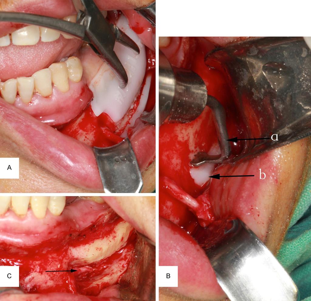 Figue 3. The process of operation. A. Location of mandibular canal by digital plate; B. Osteotomy by piezosurgery (a for the piezosurgery, b for the navigation template); C.