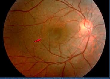 Central Serous Retinopathy Acquired Blue (Tritan) Color
