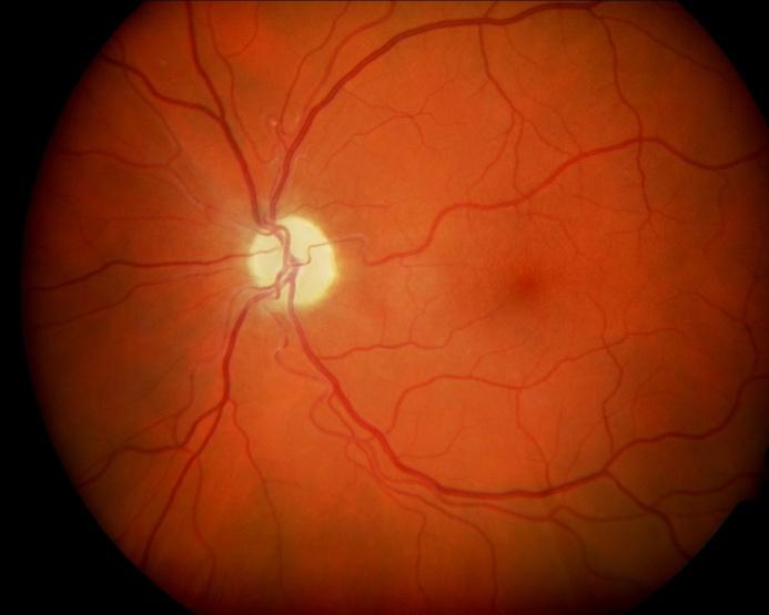 Non-arteritic Ischemic Optic Neuropathy Right eye Left eye Pale disc-optic atrophy LE RE Early 40s: painless loss of vision in left eye Developed left infero-nasal