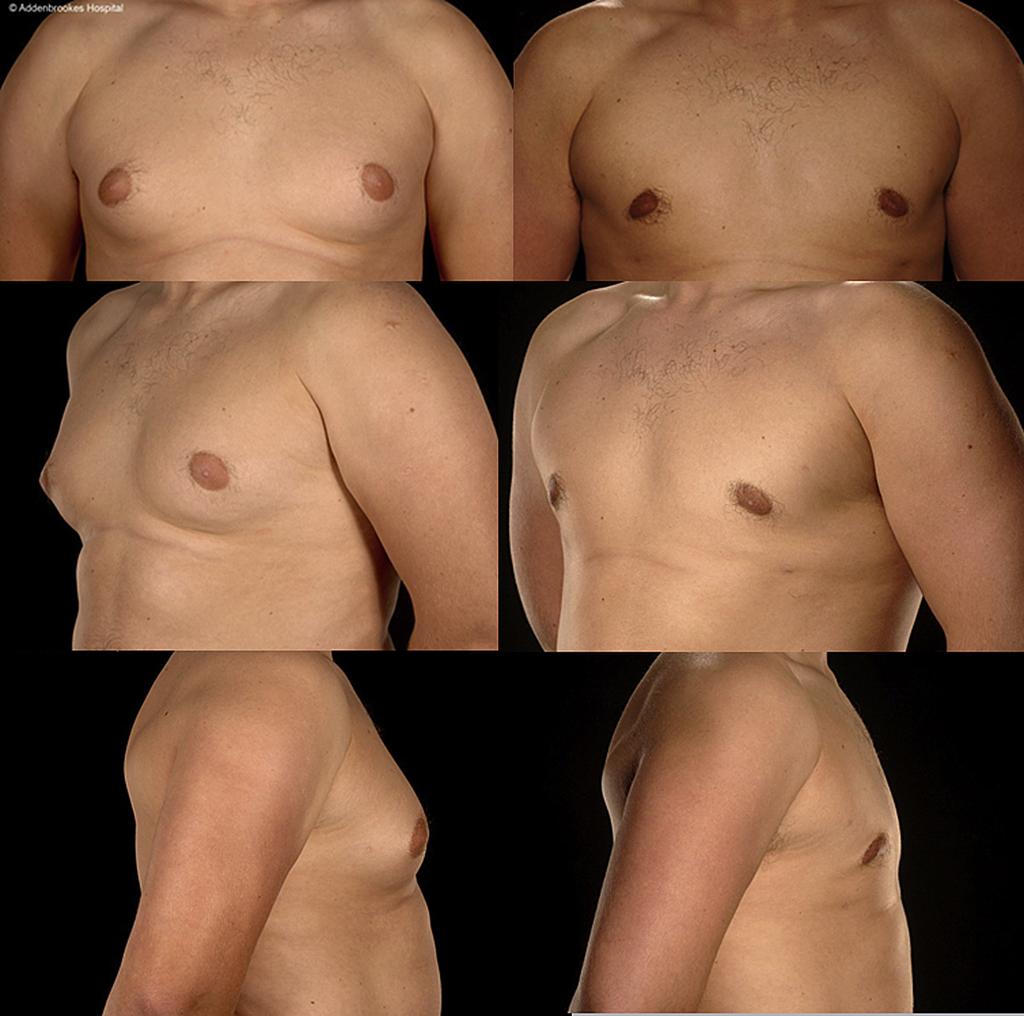 924 K.Y. Wong, C.M. Malata Figure 2 A 25-year-old patient with gynaecomastia of moderate size and consistency treated by conventional only.