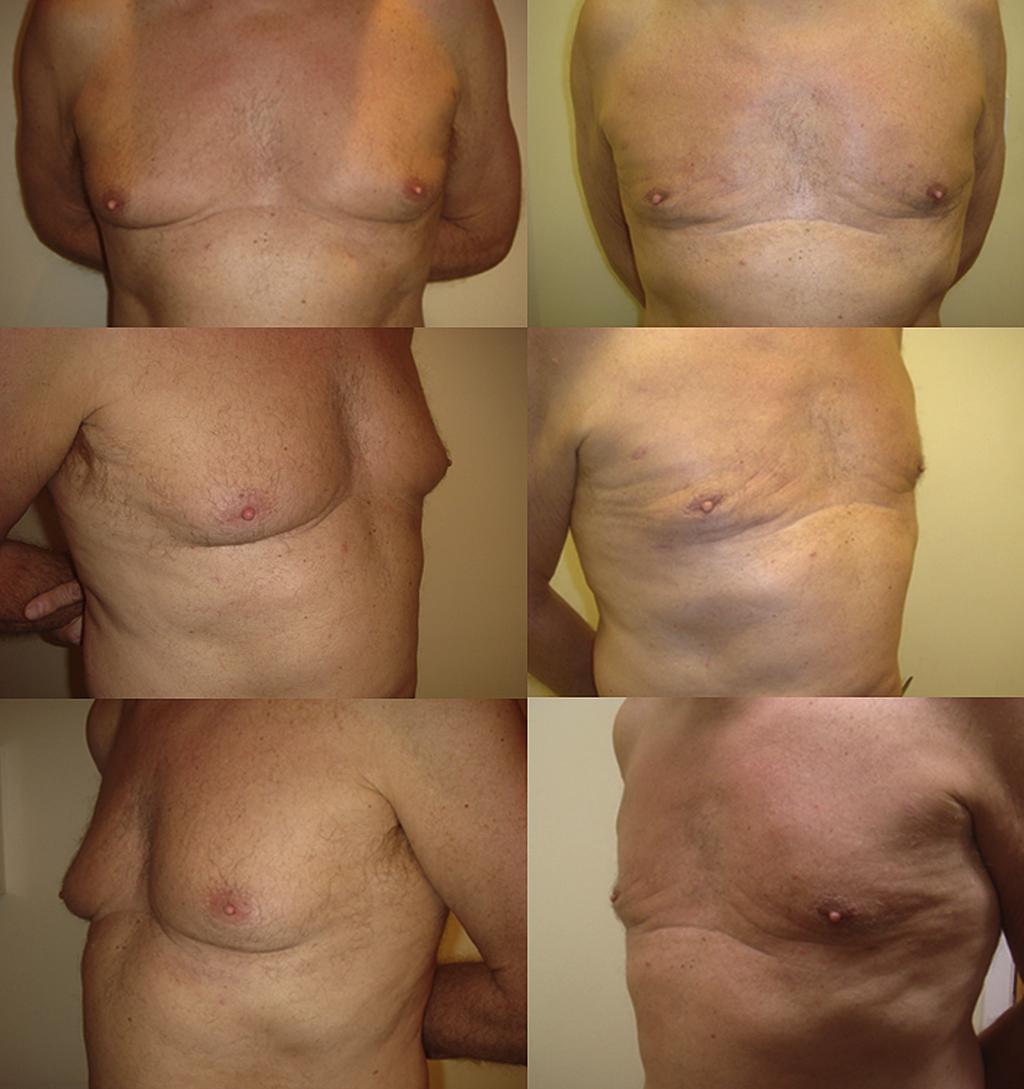 Conventional versus ultrasound-assisted in gynaecomastia surgery 925 Figure 3 A 64-year-old patient with gynaecomastia of moderate size and consistency treated by ultrasound-assisted only.
