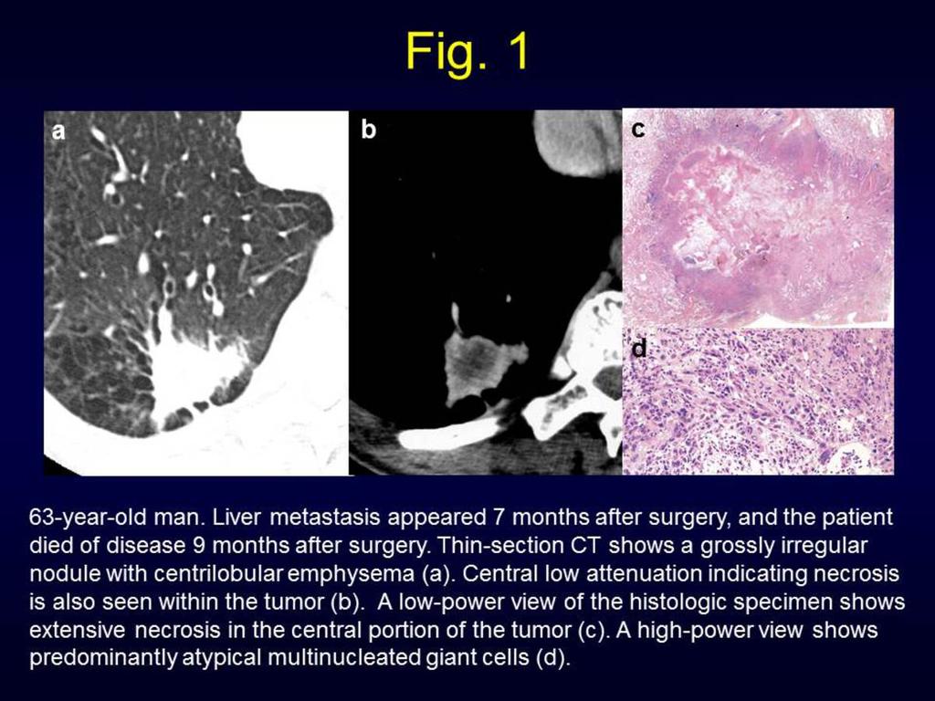 Fig. 1: 63-year-old man. Liver metastasis appeared 7 months after surgery, and the patient died of disease 9 months after surgery.