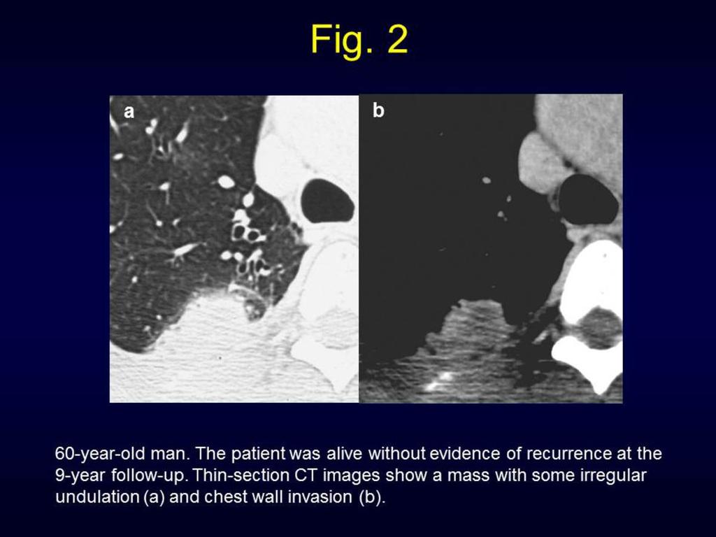 Fig. 2: 60-year-old man. The patient was alive without evidence of recurrence at the 9- year follow-up.
