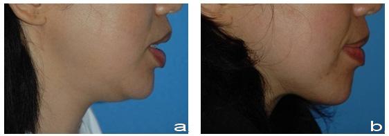 Seven days after laser lipolysis shows great appearance. Case 4. Facial adipose deposit Fig. 8. a. A female patient with adipose tissues deposit in her cheeks.