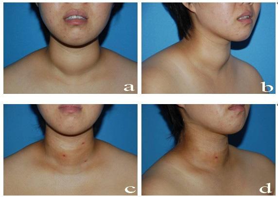 A female patient with adipose tissues deposit in her front neck. c.d. One day after laser lipolysis.