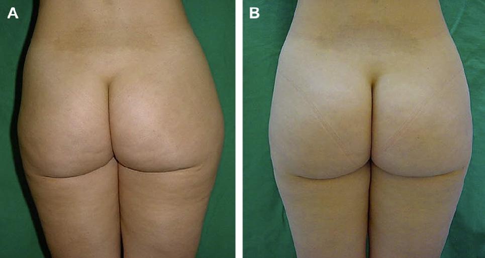 32-year-old woman is shown before (A) and 6 months after (B) laser-assisted liposuction of hips and thighs.