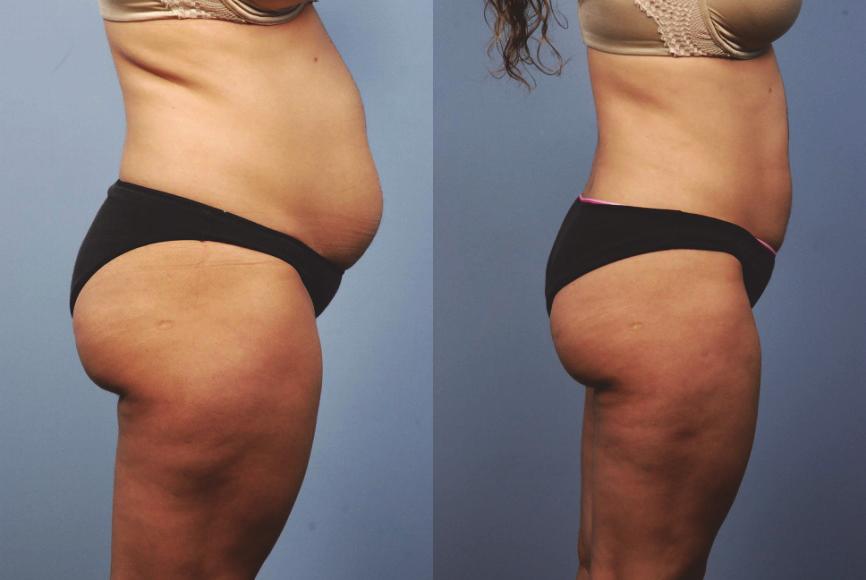 Radio-Frequency Assisted Liposuction (RFAL) 125 Fig.