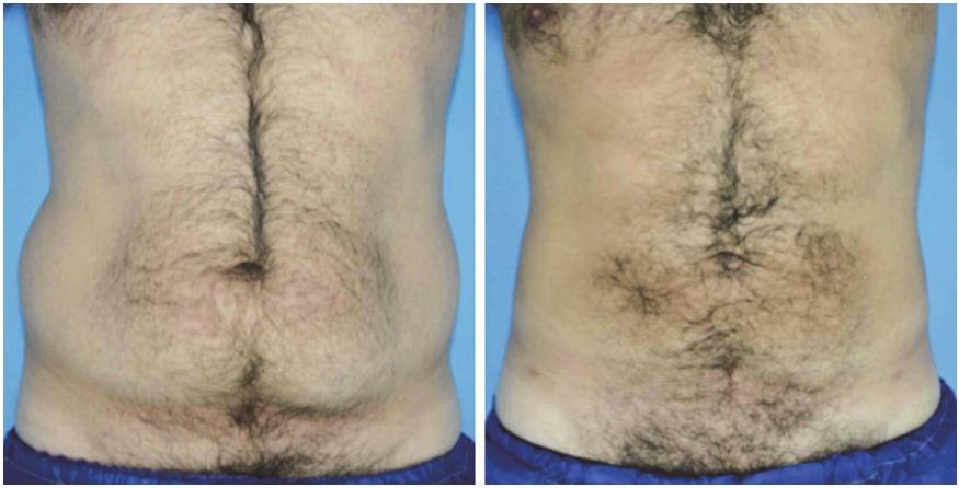 128 Advanced Techniques in Liposuction and Fat Transfer In spite of improved contraction obtained at higher energies, the amount of energy during the treatment should be measured and controlled to