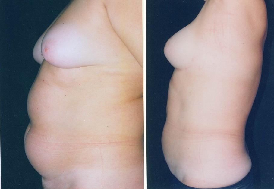 Ultrasound Assisted Liposculpture UAL: A Simplified Safe Body Sculpturing and Aesthetic Beautification Technique 145 A. B. Fig. 5. A. Before. A 90 kg female patient, B.