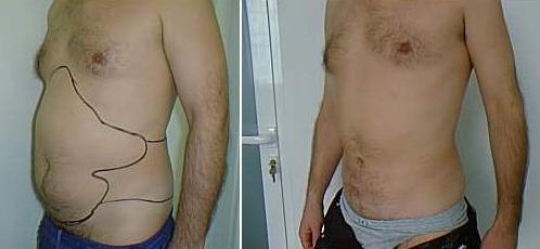 Result after 4 months after abdomen and flanks UAL. Loss of fat all around the body - visible loss of volume in the upper arm. B. A. B. Fig. 7. A. Before, B.