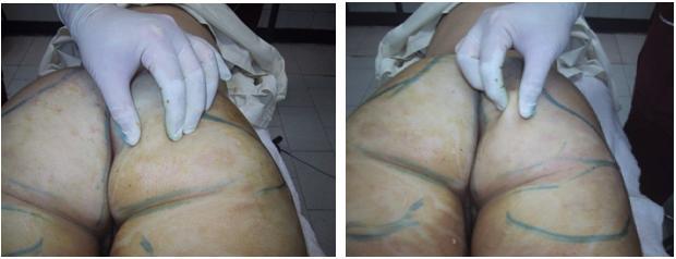MAST (Manual Assisted Stabilization Tissue) is a very helpful maneuver in which an assistant presses on the buttock to prevent accompanying the movements of the tissues performed by the surgeon s