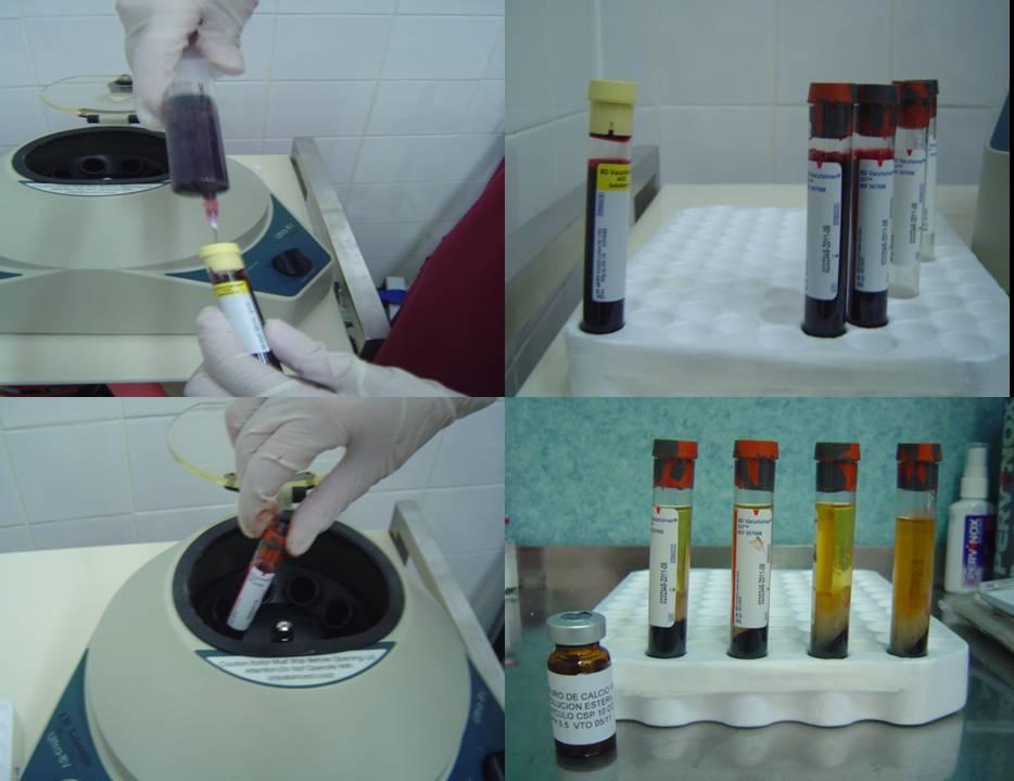 162 Advanced Techniques in Liposuction and Fat Transfer Fig. 9. Blood components separation process. The blood is collected in tubes of 8.5 ml.