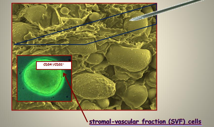 210 Advanced Techniques in Liposuction and Fat Transfer This is to collect the stromal-vascular fraction, where stem cells are located, [18] and to avoid injury to these very sensitive cells.