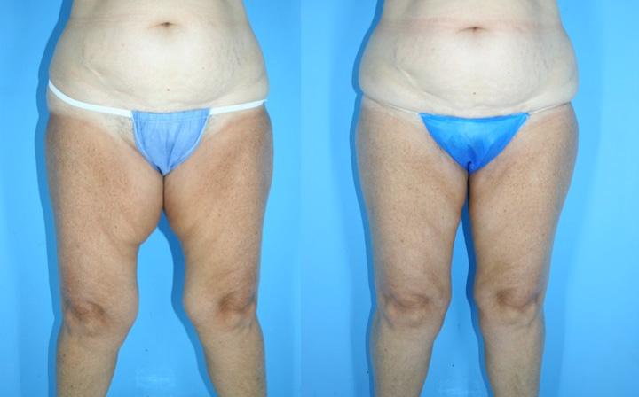 Application of the Liposuction Techniques and Principles in Specific Body Areas and Pathologies 21 Fig. 23.