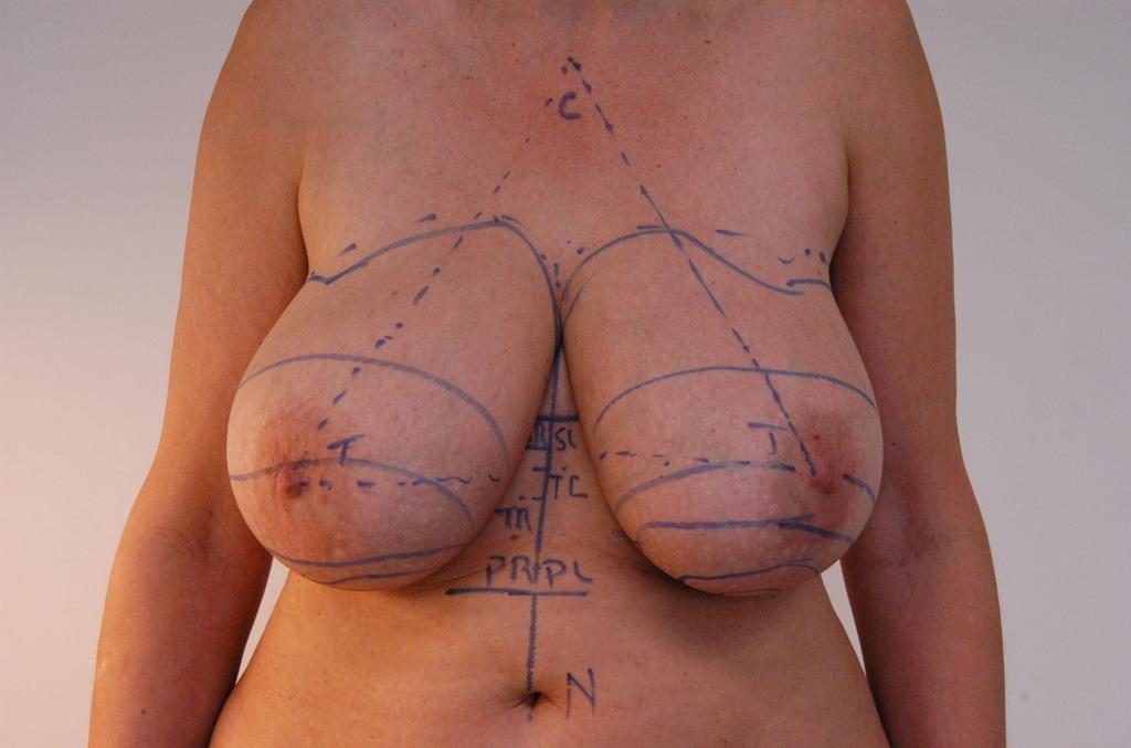 Application of the Liposuction Techniques and Principles in Specific Body Areas and Pathologies 25 Fig.