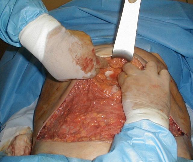 Caution was given to specifically resect only the dermis and preserve the subcutaneous structures.