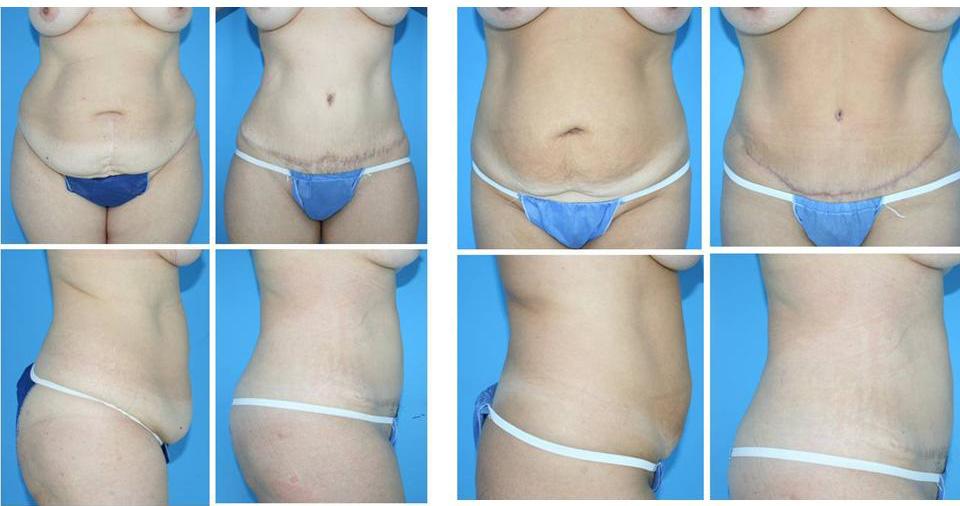 30 Advanced Techniques in Liposuction and Fat Transfer In cases with rectus diastasis (n=27), the undermining of the median plane was continued superiorly until the xiphoid.